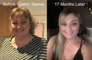 Danielle before surgery and 17mth later