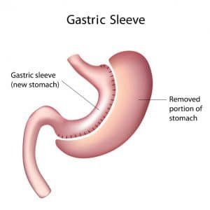 Gastric sleeve surgery