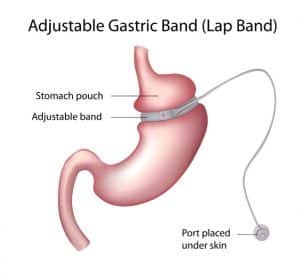 adjustable gastric band surgery