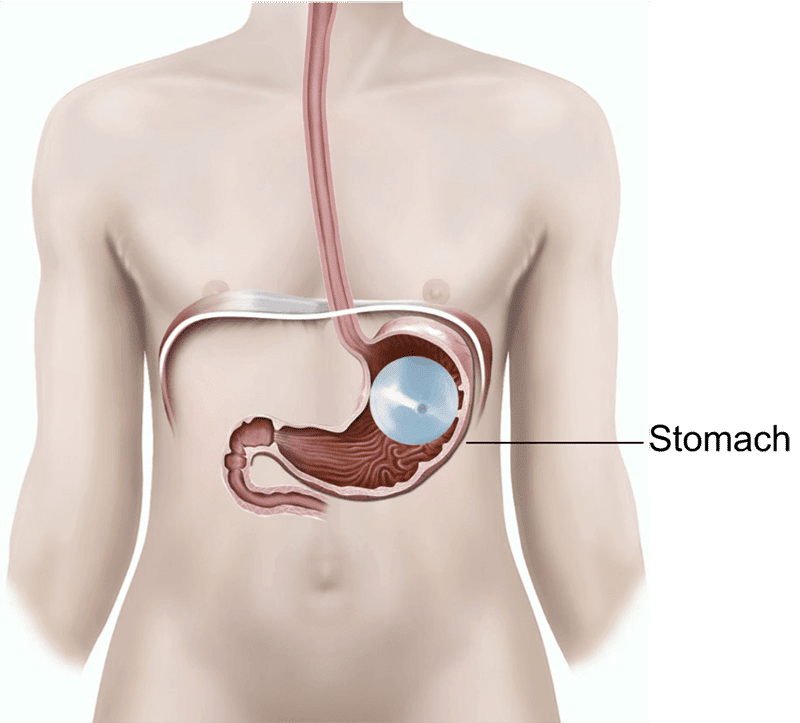 Gastric Balloon