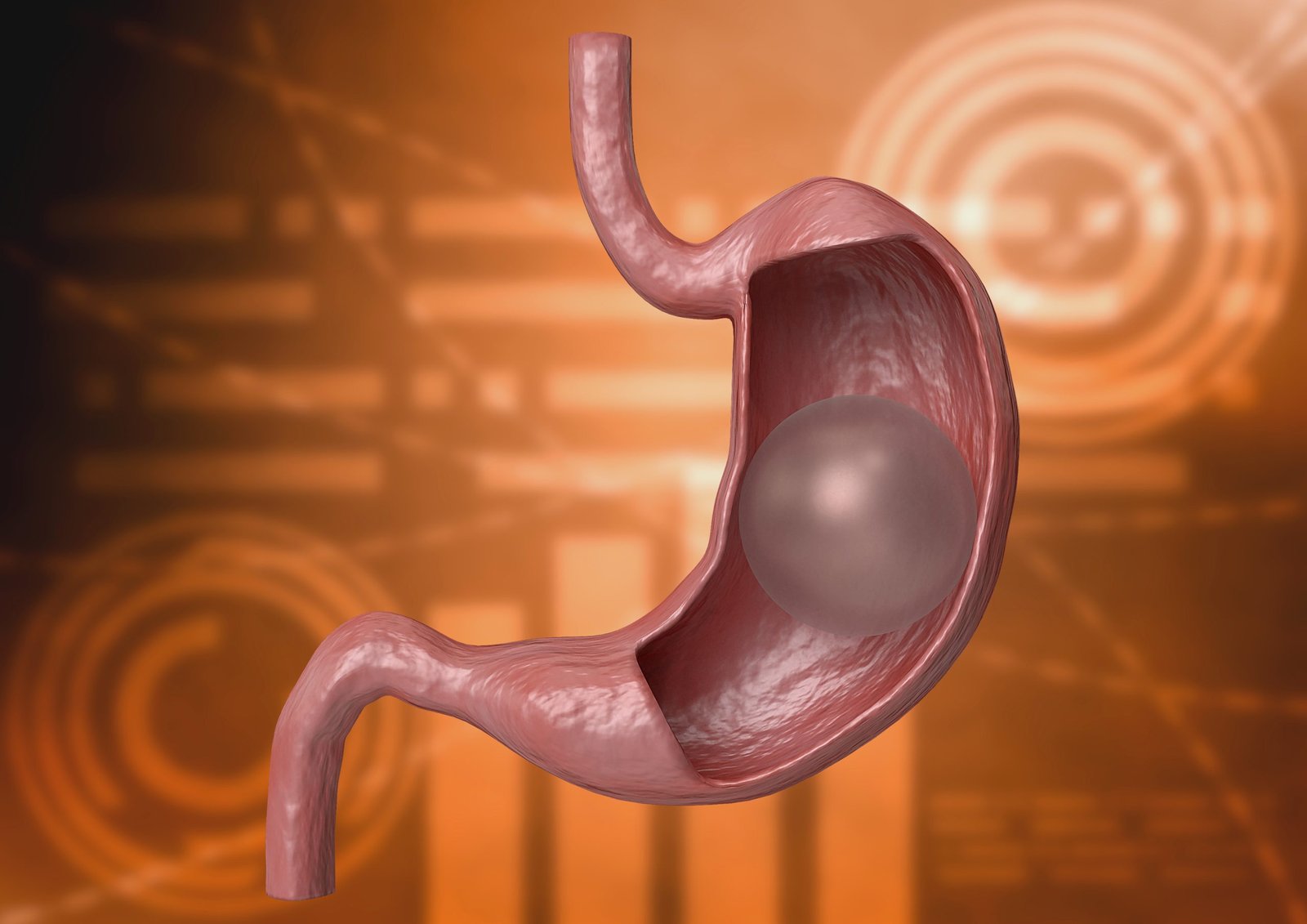 A 3D image of gastric balloon inside the stomach.