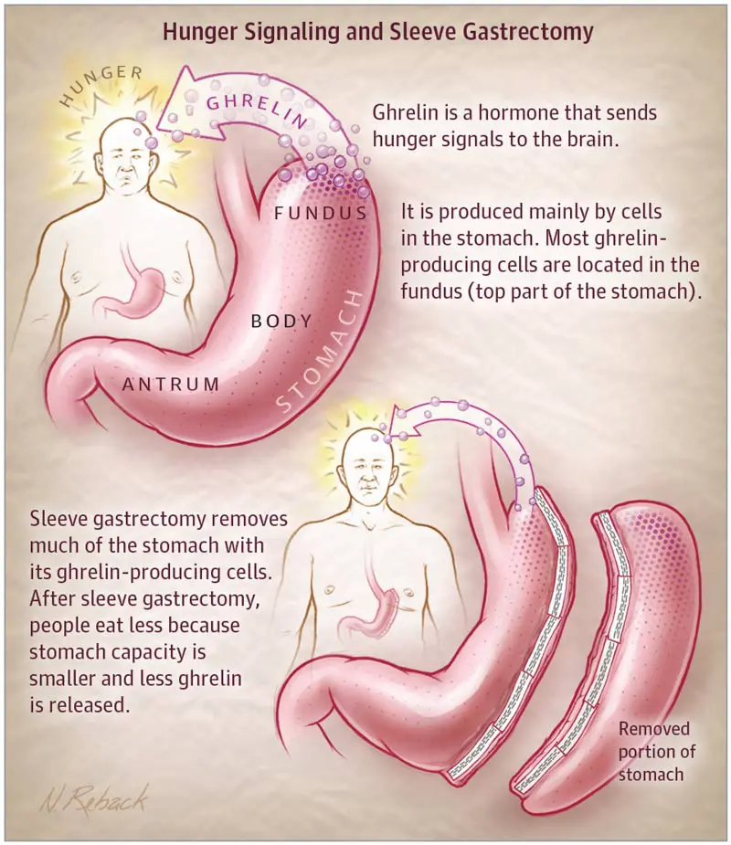 Gastric sleeve surgery reduces hunger by removing ghrelin-producing cells