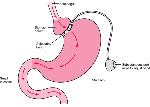 Gastric Banding Surgery