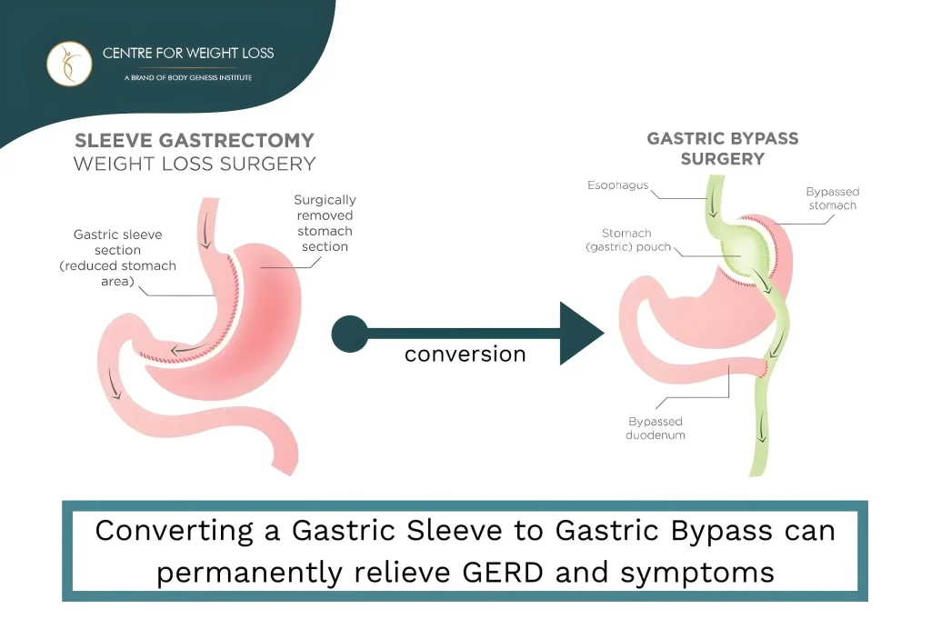 Conversion to gastric bypass (RYGB)
