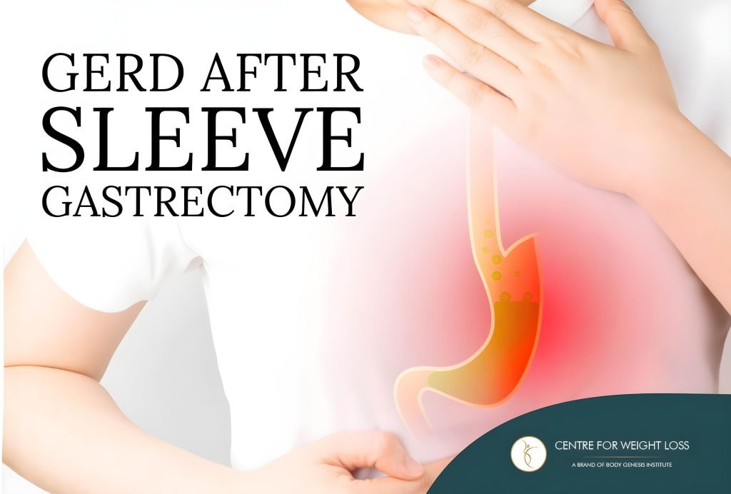 Acid reflux after gastric sleeve surgery